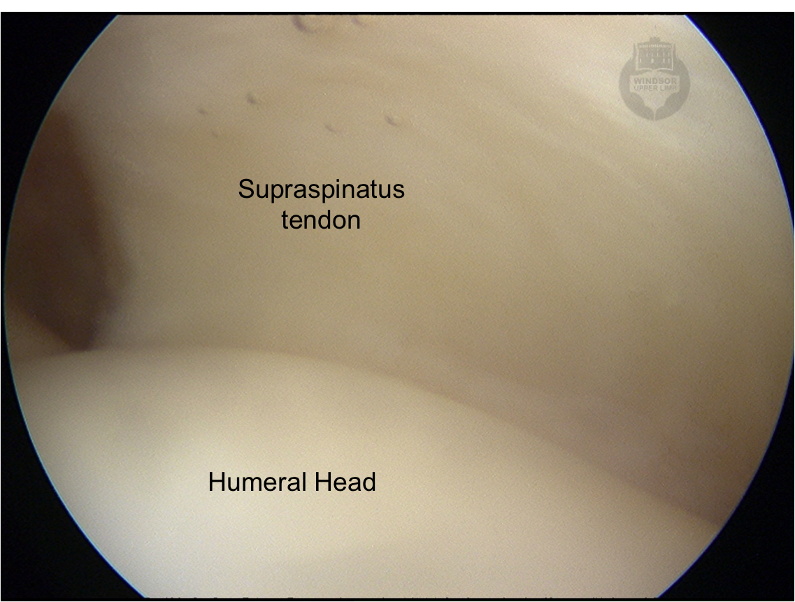 Shoulder Arthroscopy
